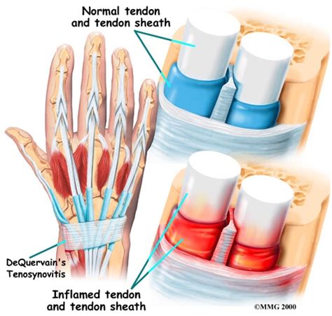 What Is De Quervains Tendinitis Southern Hand Wrist