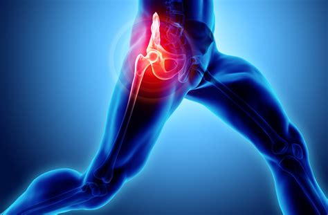 Managing Pain After Hip And Knee Joint Replacement Surgery West