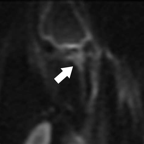 Mri Of Orbital Cellulitis And Orbital Abscess The Role Of Diffusion