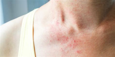 18 Common Skin Rash Pictures How To Id Skin Rash Symptoms