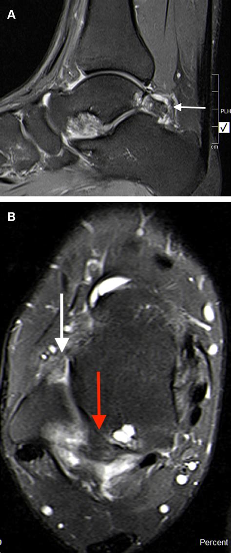 Chronic lateral ankle instability increases the likelihood ...