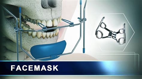Facemask Orthodontic Headgear Appliance 3d Animation Youtube