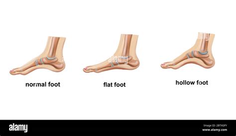 Medical Illustration Of The Flat Foot Stock Photo Alamy