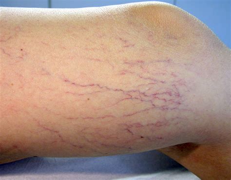 See more of como eliminar varices en piernas: Consejos para eliminar las varices