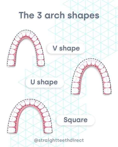 Arch Expansion In Orthodontics What Is It