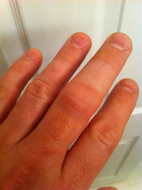 Smashed Middle Finger