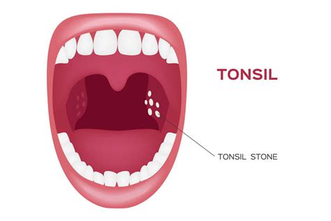 Tonsil Stones Ent Consultants