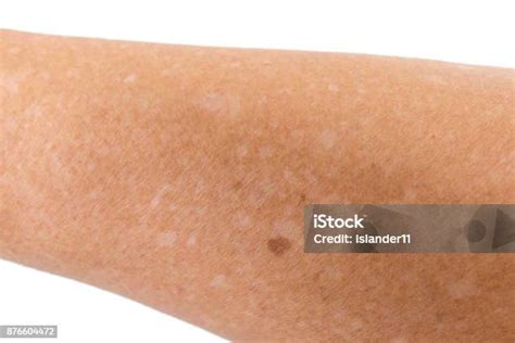 Small White Spots On Arms Liver Spots On The Skin Of An Old Person