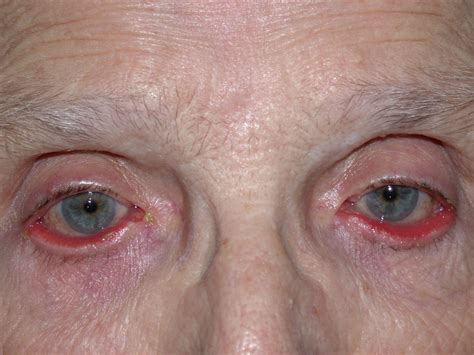 Eyelid Plastic And Reconstructive Surgery Warwar Eye Group