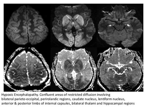 Amol Toxic And Metabolic Encephalopathy Syndrome