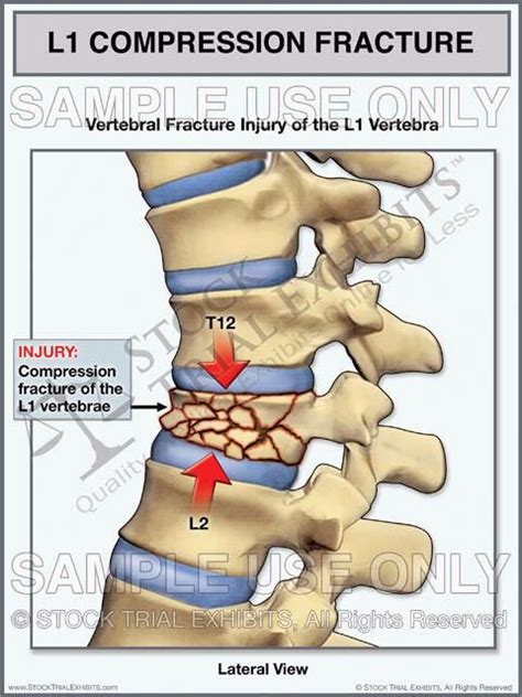 Neurosurgeon first wanted to operate but because of my age (29) no surgery he gave me brace and bed rest i fractured t11 to l1 and came back to climbing pretty handily. Pin on FRACTURES