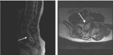 Surgical Management Of Tethered Cord Syndrome In Adults Indications