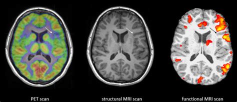 Difference Between Mri And Fmri