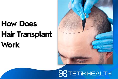 How Does Hair Transplant Work Tetik Health
