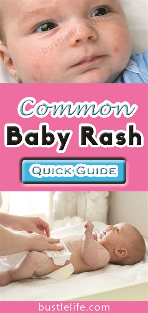Types Common Baby Rashes Ultimate Guide To Health Care