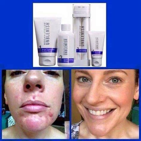 Rodan Fields Results Send Me A Message To Start Your Before And