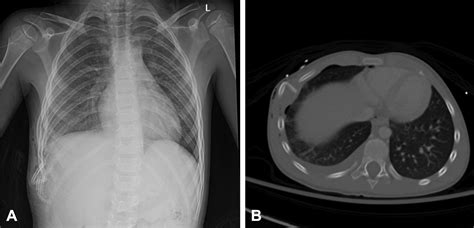 Surgical Stabilization Of Rib Fractures In A 6 Year Old Child After
