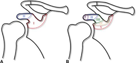 a Eyres classification of coracoid process fractures. Type ...
