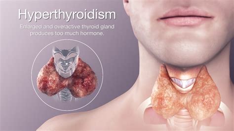 Know About How To Manage Our Thyroid Level Liv Healthy Life