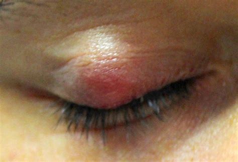 How To Remove A Cyst On Eyelid At Home