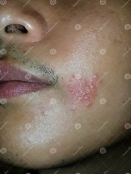 Skin Infected Herpes Zoster Shingles Virus On The Face Cheek Editorial