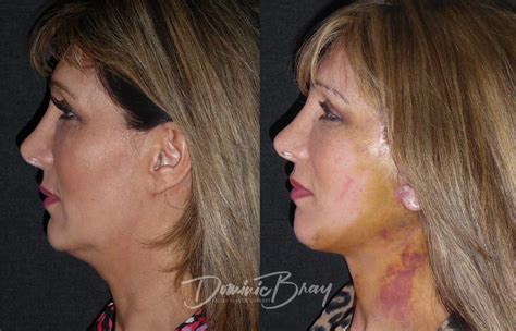 Shara 54 45 54 Face And Necklift Jowls Liposculpture Neck Dr Dominic Bray