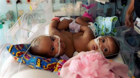 Conjoined Twin Sisters Undergo Successful Surgery To Separate Village