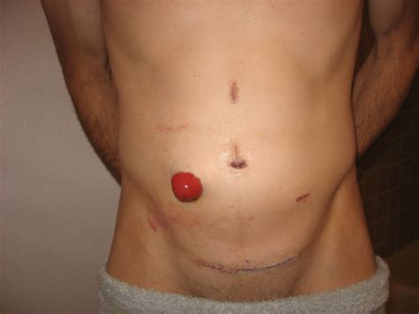 A prognosis is the doctor's best estimate of how cancer will affect someone and how it will respond to treatment. Pic 13: Stoma, Incisions, Day 8 | Full surgery ...