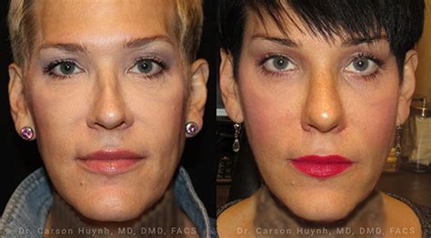 V Line Jawline Surgery In Atlanta And Nyc Radiance Surgery And
