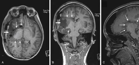 Mapping Disconnection And Resective Surgery In Pediatric Epilepsy
