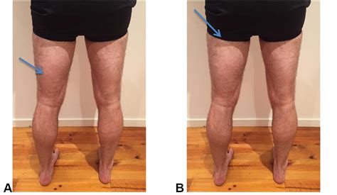 Several factors can predispose players to injury, including older age, previous hamstring injury, less flexibility in the hamstrings, lack of hamstring strength, and fatigue. Hamstring Injury Management & Prevention - South Coast ...