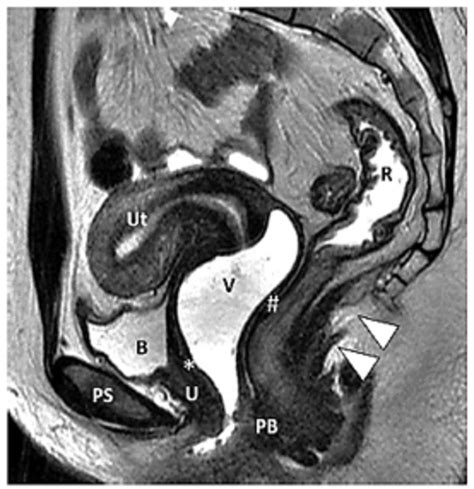 Normal Female Pelvic Floor Anatomy Sagittal T Weighted MR Image Shows Download Scientific
