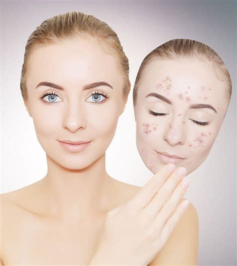 Hyperpigmentation Mask Cheek Acne Dark Spots On Face Brown Spots