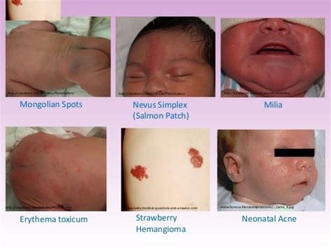 Pediatrics Pediatrics Neonatal Acne Nicu Nurse