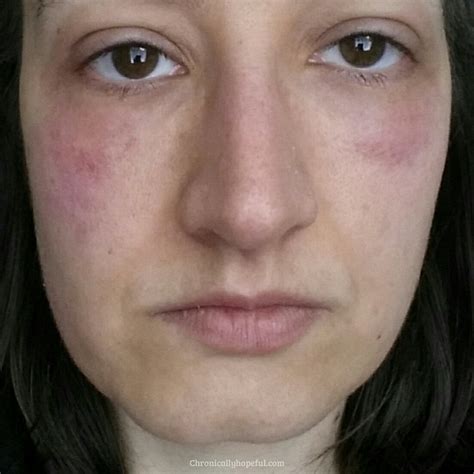 Rash On My Face Histamine Intolerance Chronically Hopeful Allergy