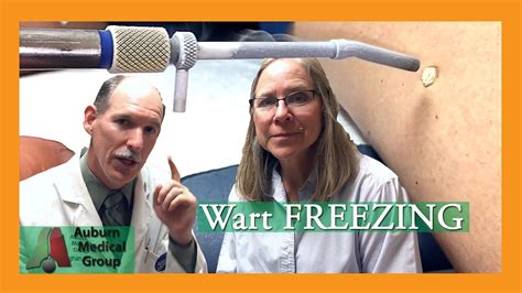 Wart Freezing Auburn Medical Group Youtube
