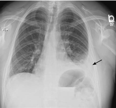 A large pericardial effusion >20 mm with concomitant pleural effusion is also evident posteriorly to the aorta. Loculated Pleural Effusion Definition / Approach To ...