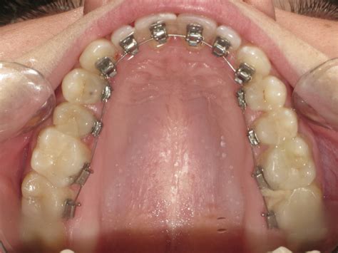 Check spelling or type a new query. How much does Lingual braces cost UK? Lingual cost London