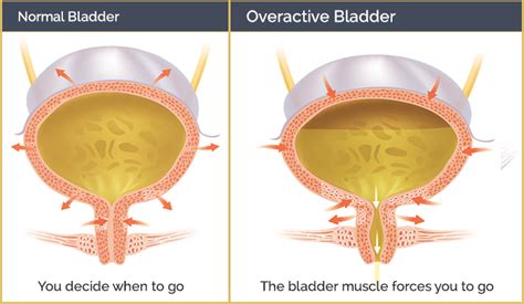 Overactive Bladder Faq Urologic