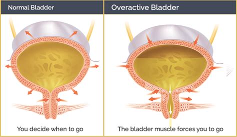 Overactive Bladder FAQ Urologic