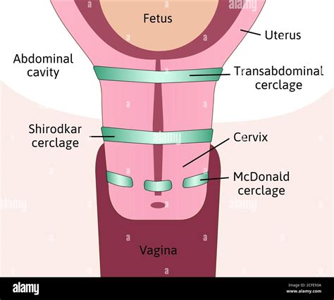 Three Types Of Cervical Cerclage Or Cervical Stitch Treatment For