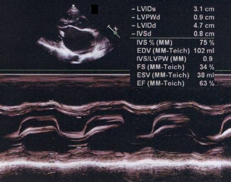 What Is M Mode Echocardiography All About Cardiovascular System And