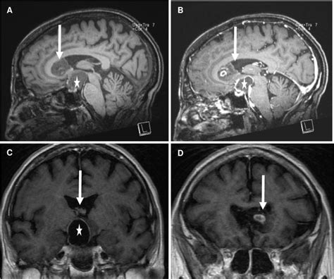 Pre Operative Brain Imaging Demonstrating Two Synchronous Brain Tumors