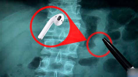 Man Swallows An Apple Airpod While Sleeping Found Out It Is Still