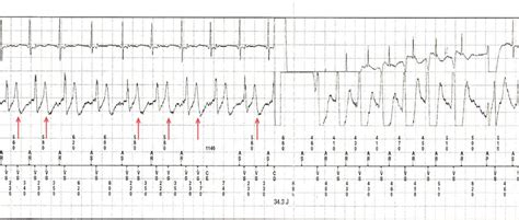 T Wave Oversensing In Patients With Brugada Syndrome True Bipolar