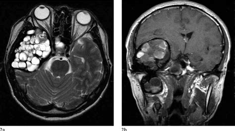 Figure From Aneurysmal Bone Cyst Of Skull Base A Case Report And Review Of Literature