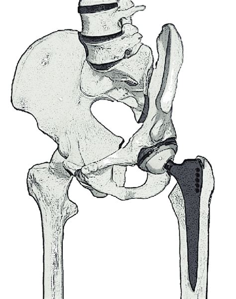 Total Hip Replacement Thr Displayed In The Surrounding Bone With Cut