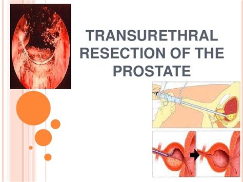 Nursing Transurethral Resection Of The Prostate