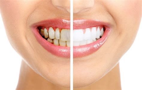 What Causes Stained Teeth Britt Dental Center Raleigh Nc Dentist