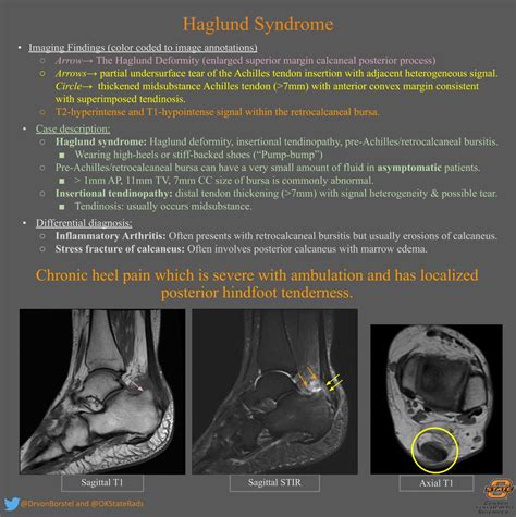 Haglund Syndrome Msk Radiology Imaging Findings Grepmed